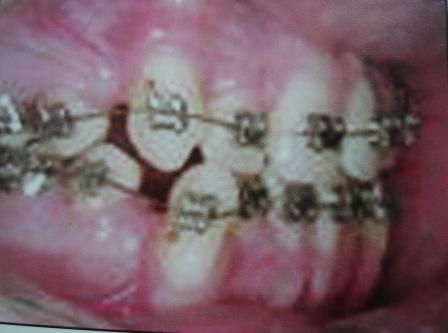 INTERMEDIRIA COM 4 EXTRAES