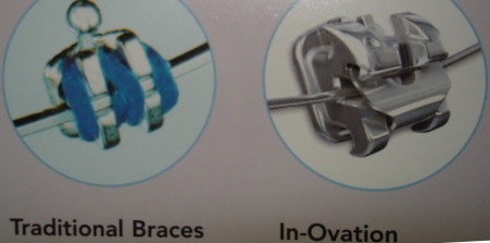 BRAQUETES