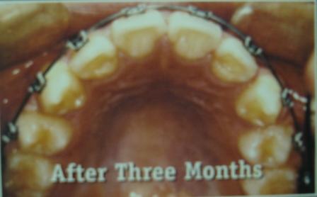 3 MESES P�S